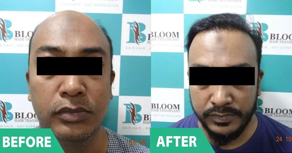 male hair transplant cost