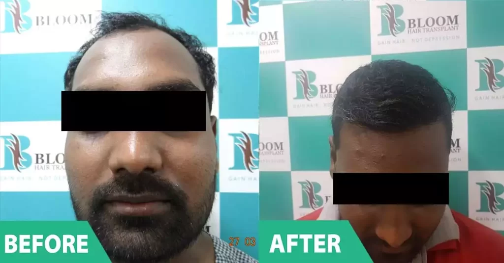 hair transplant female before and after