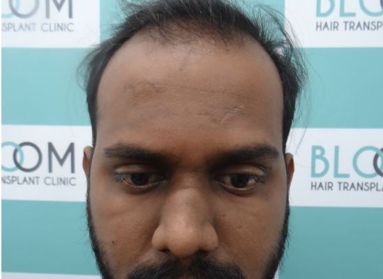 near hair transplant