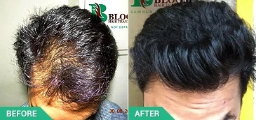 hair transplant direct hair transplantre in mumbai