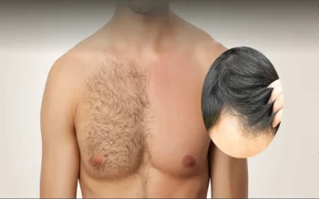 All About Body Hair Transplant