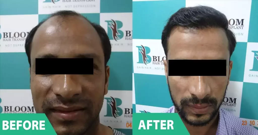 best hair transplant surgeon mumbai