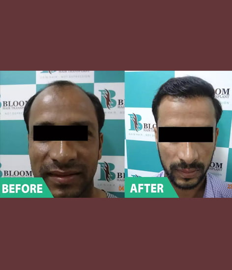 fue hair transplant bandra