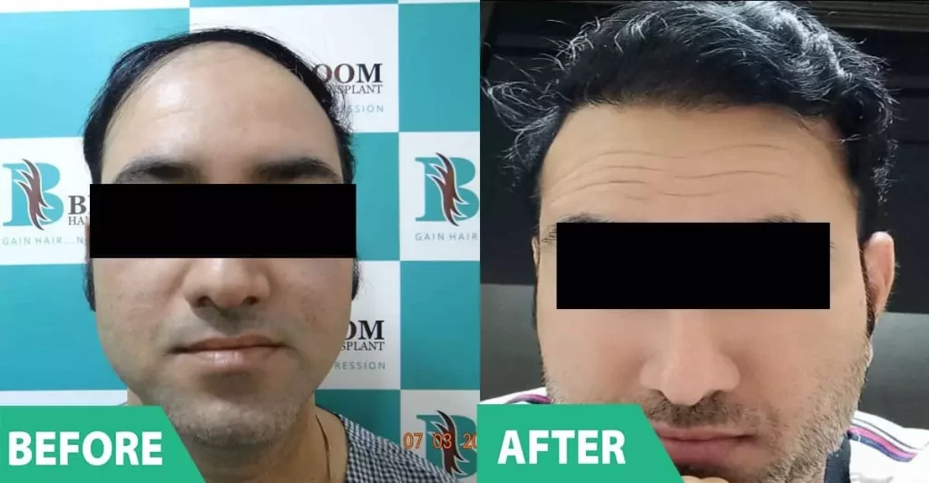 Sapphire Hair Transplant dr mumbai