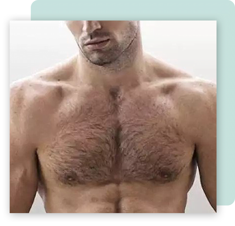 Body Hair Transplant in Mumbai