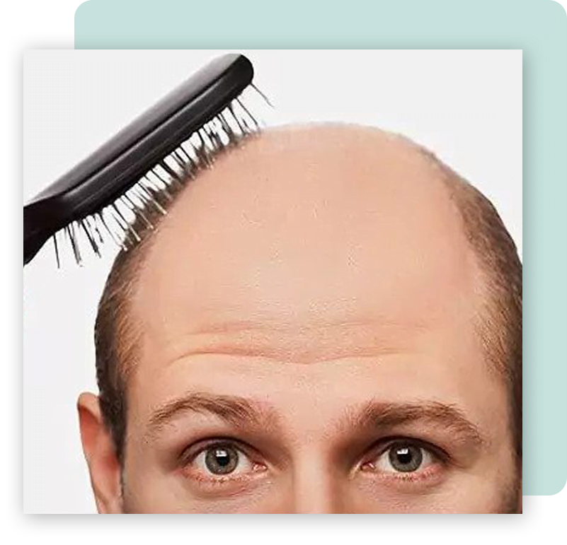 fue hair transplant