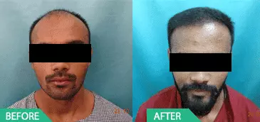 hair transplant operation