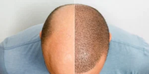 Hair transplant procedure