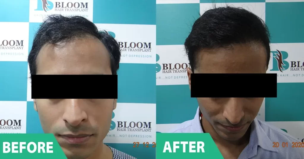 after hair transplant hair loss