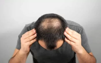 Need of Hair Transplant for your Baldness