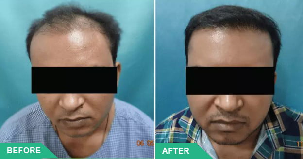 hair implant cost mumbai