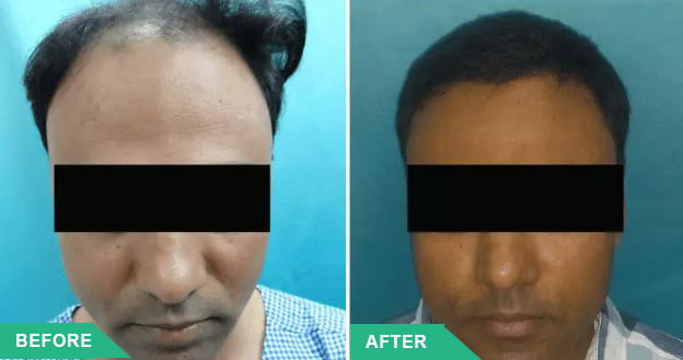 hair transplant pune