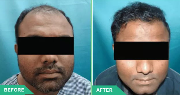 hair transplant best in mumbai