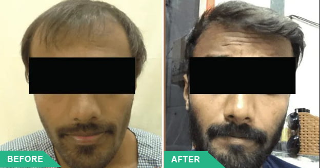 hair transplant mumbai hospital