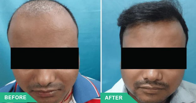 hair transplant appointmdirect hair transplant