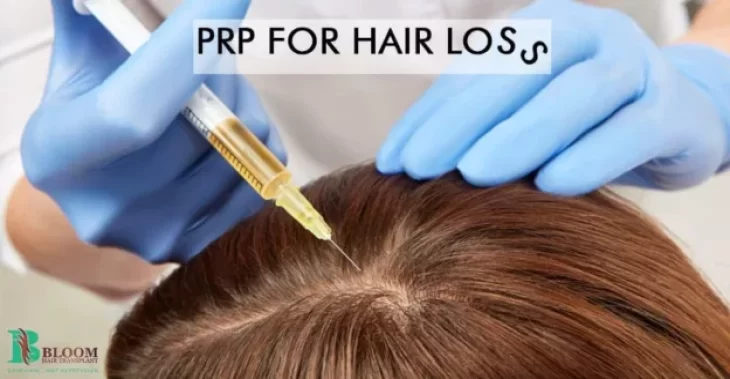 PRP for Hair Loss