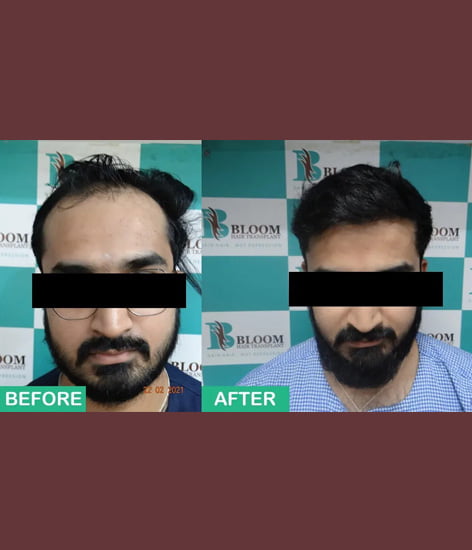 bandra Female hair transplant