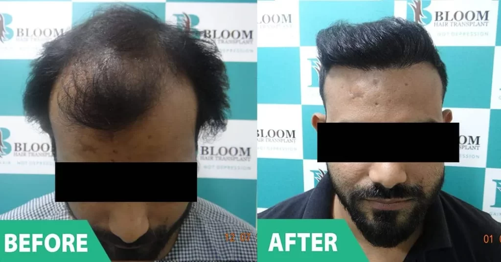 hair treatment direct hair transplant dr near me