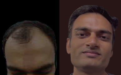 saphire hair transplant