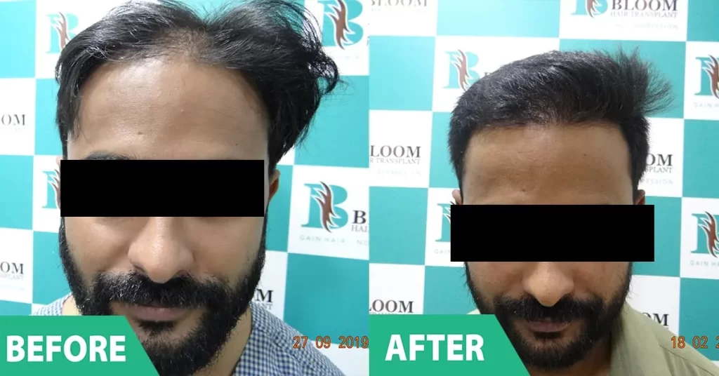 effects of hair transplant