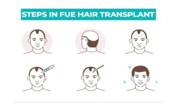 Steps In FUE Hair Transplant