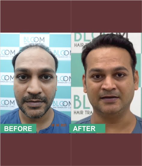 fue treatment direct hair transplant near me