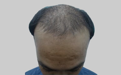 best hair transplant