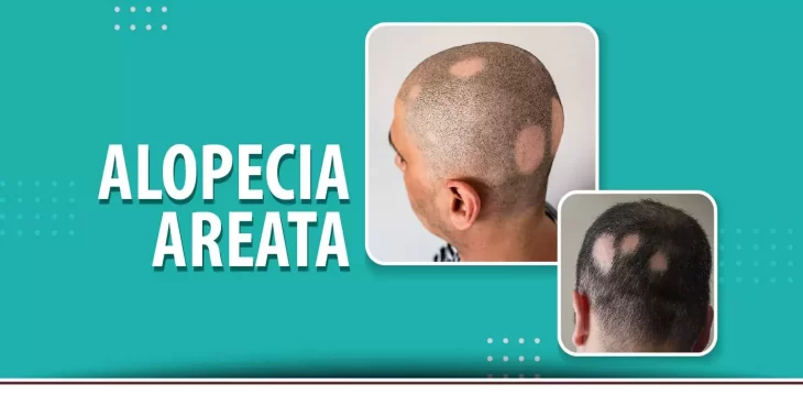 Want To Know The Proper Explanation Of Alopecia Areata? Read It Below