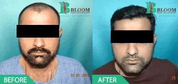 hair transplant how much does it cost