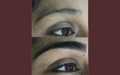 Eyebrows hair Restoration In Mumbai