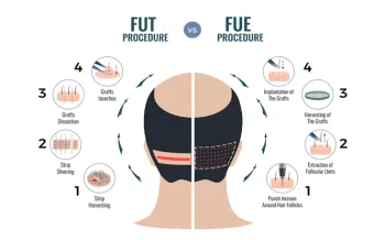 FUT Vs FUE! Which One Is Better For You?