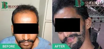 hair transplant surgeons near me