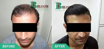 price for hair transplant in india