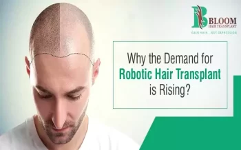 Rising Demand For Robotic Hair Transplant In Mumbai