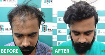 hair grafting in pune