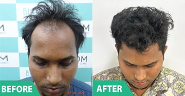 hair implant in mumbai