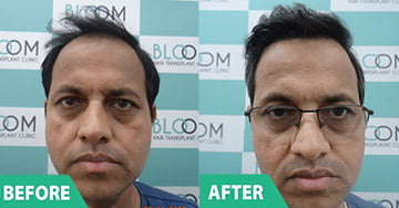 Robotic Hair Transplant doctor mumbai