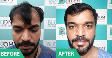 best hair transplant direct hair transplanter in india