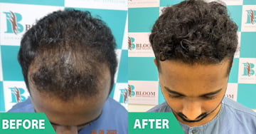 best hair plantation in india