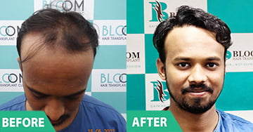 cost for hair transplant in mumbai