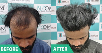 hair implant near me