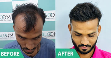 best doctor Direct Hair Transplant (DHT) & Follicular Unit Extraction (FUE) in mumbai