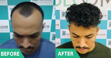 best hair transplant direct hair transplantre in mumbai