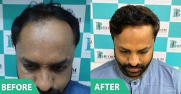 best hair transplant