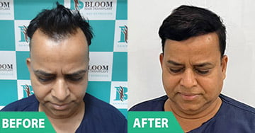 cost of Restoration of failed hair transplant in mumbai