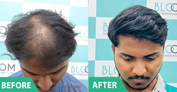 hair implant cost in mumbai