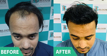 best hair transplant in india