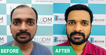 best hair transplant in mumbai ncr