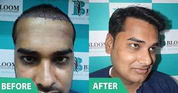 Sapphire Hair Transplant doctor in mumbai