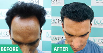 cost of robotic hair transplant growth Hair Transplantnt in mumbai